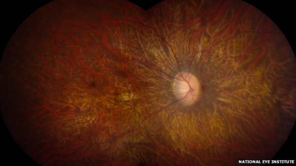 Gene therapy improves eye sight temporarily