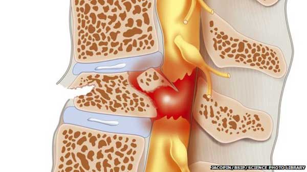Spinal cord injury cancer drug hope