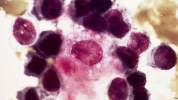 Blood test ‘detects cancer relapse’