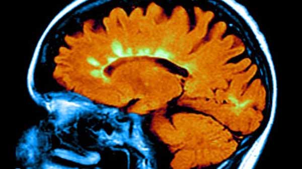 Low vitamin-D genes linked to MS