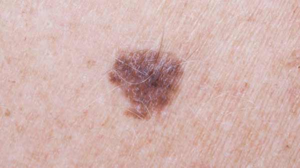 Arm mole count ‘predicts skin cancer risk’