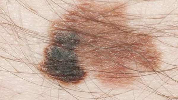 Fast-tracked skin cancer drug approved