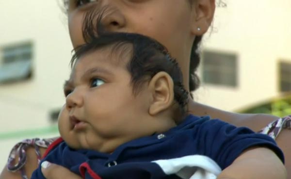 Concern Zika causes baby eye problems