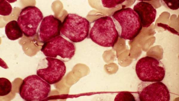 Study says a major blood cancer is 11 distinct diseases
