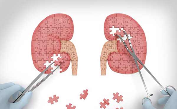 Kidney failure patients on dialysis at early death risk