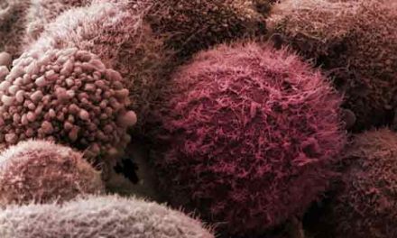 Major pancreatic cancer study launched